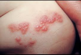 Illustration for article titled obat herpes manjur